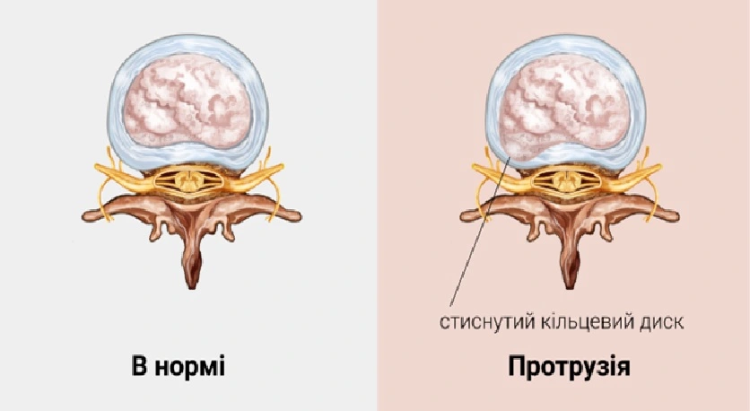 Фото хряща нормального і з протрузією